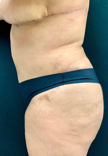 Tummy Tuck case #2544