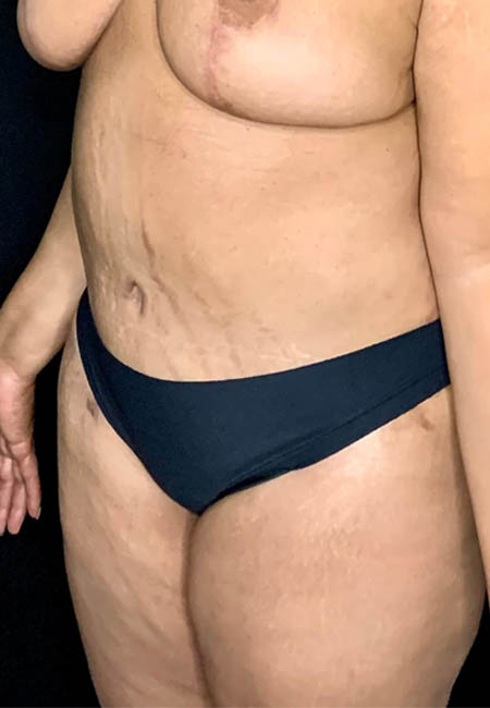 Tummy Tuck case #2544