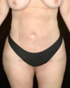 Liposuction case #2657