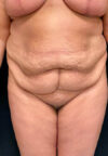 Tummy Tuck case #2544