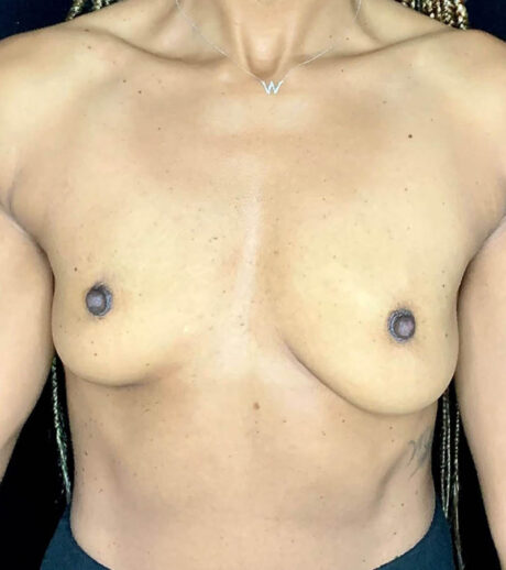 Breast Augmentation case #2587