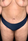 Tummy Tuck case #2544