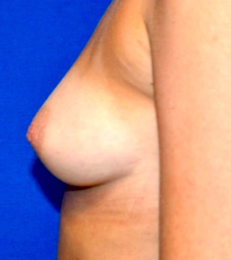 Breast Augmentation case #2598