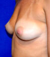 Breast Augmentation case #2598