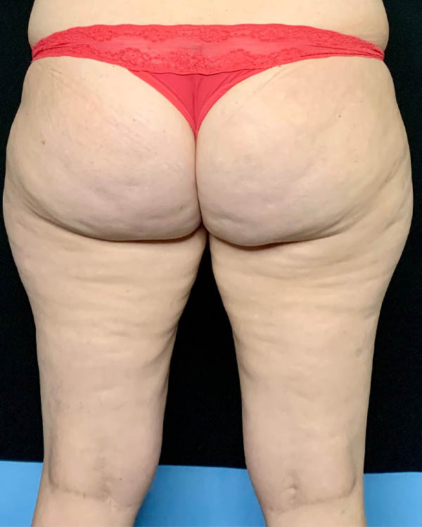 Liposuction case #2657