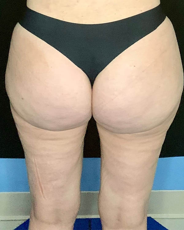 Liposuction case #2657