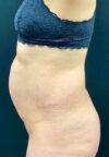 Tummy Tuck case #2560