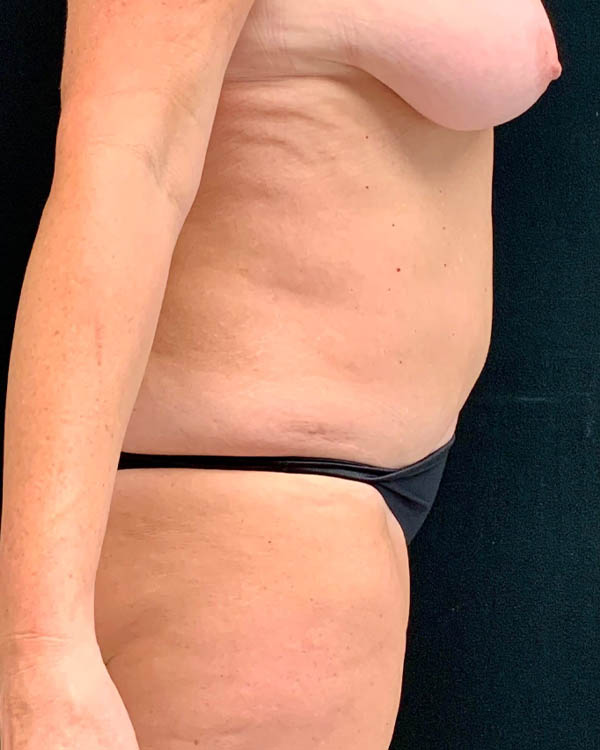 Liposuction case #2473