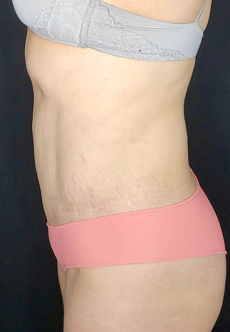 Tummy Tuck case #2560