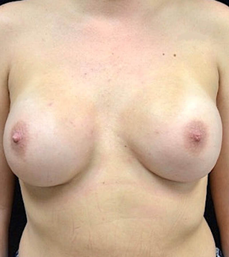 Breast Augmentation case #2598