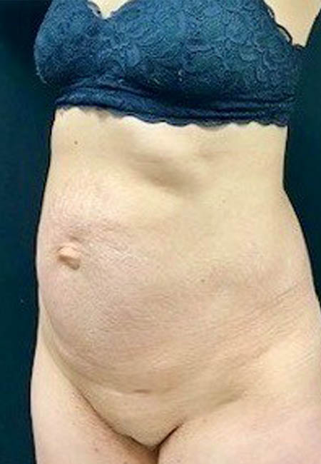 Tummy Tuck case #2560