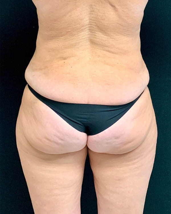 Liposuction case #2473