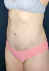 Tummy Tuck case #2560