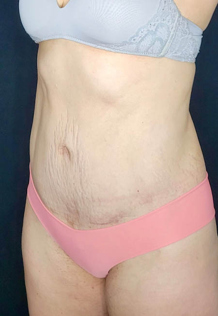 Tummy Tuck case #2560