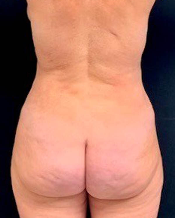 Liposuction case #2473