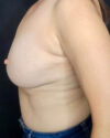 Liposuction case #2459