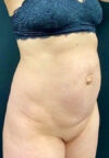 Tummy Tuck case #2560