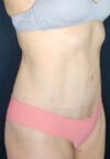 Tummy Tuck case #2560