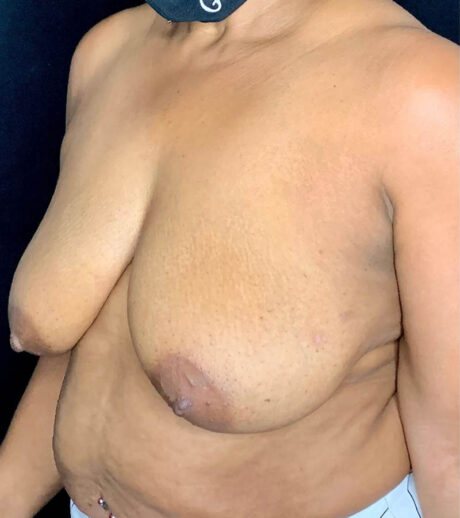 Breast Lift case #2609