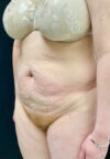 Tummy Tuck case #2575