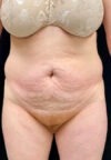 Tummy Tuck case #2575