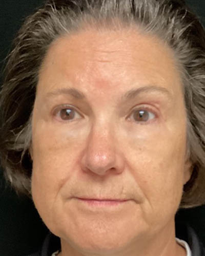 Blepharoplasty case #3127