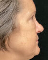 Blepharoplasty case #3127