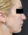 Rhinoplasty case #3138