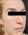 Rhinoplasty case #3138