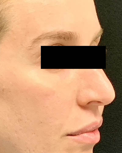 Rhinoplasty case #3138