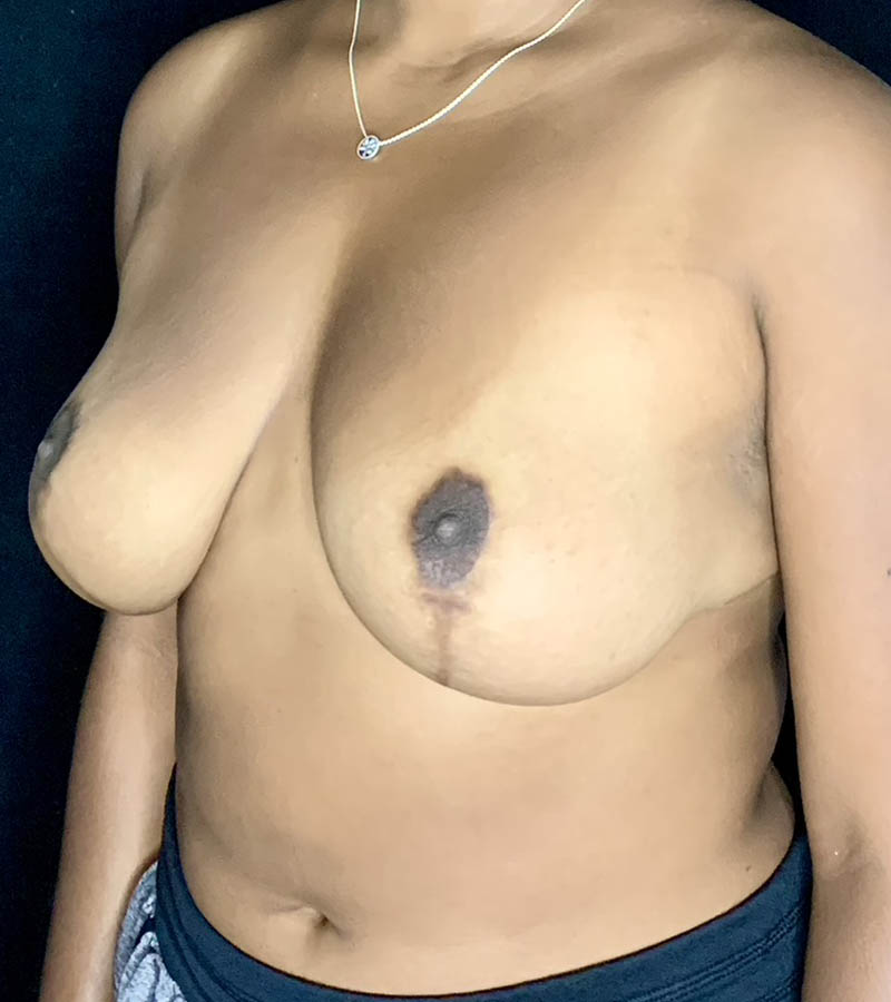 Breast Lift case #3078