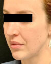 Rhinoplasty case #3138