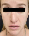 Rhinoplasty case #3138