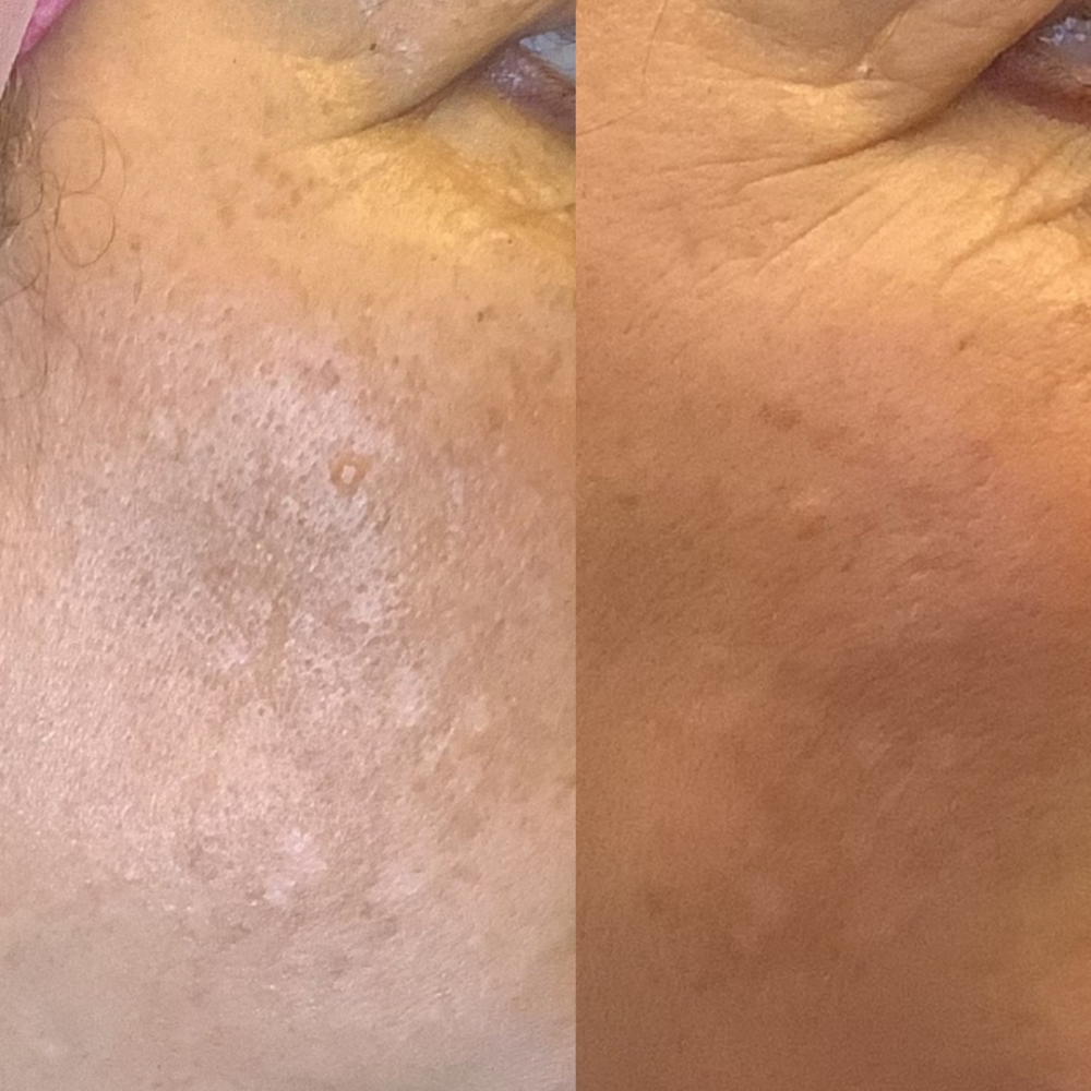 Chemical Peel case #3214