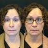 Neurotoxin (Botox) case #3236