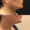 Kybella case #3233