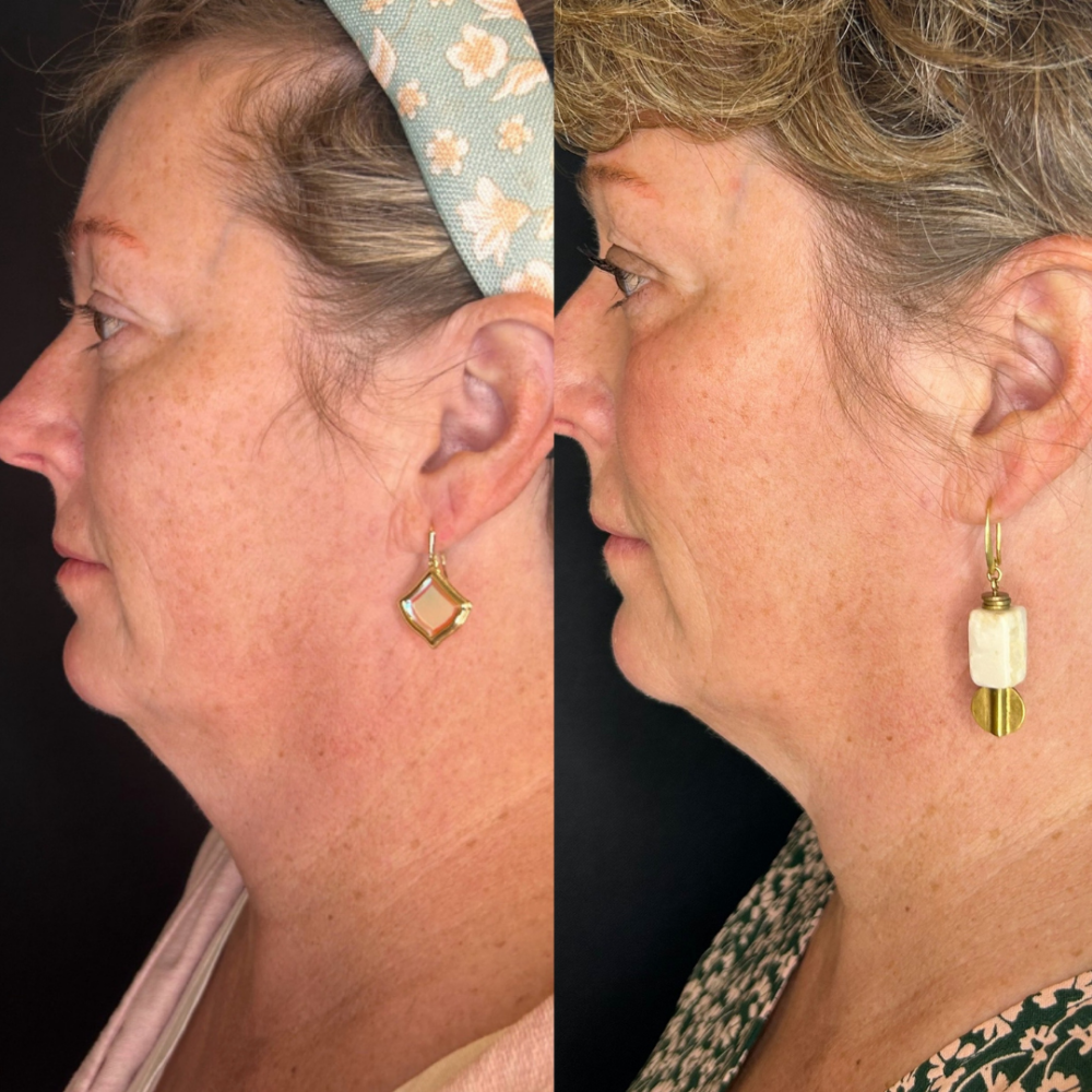 Kybella case #3229