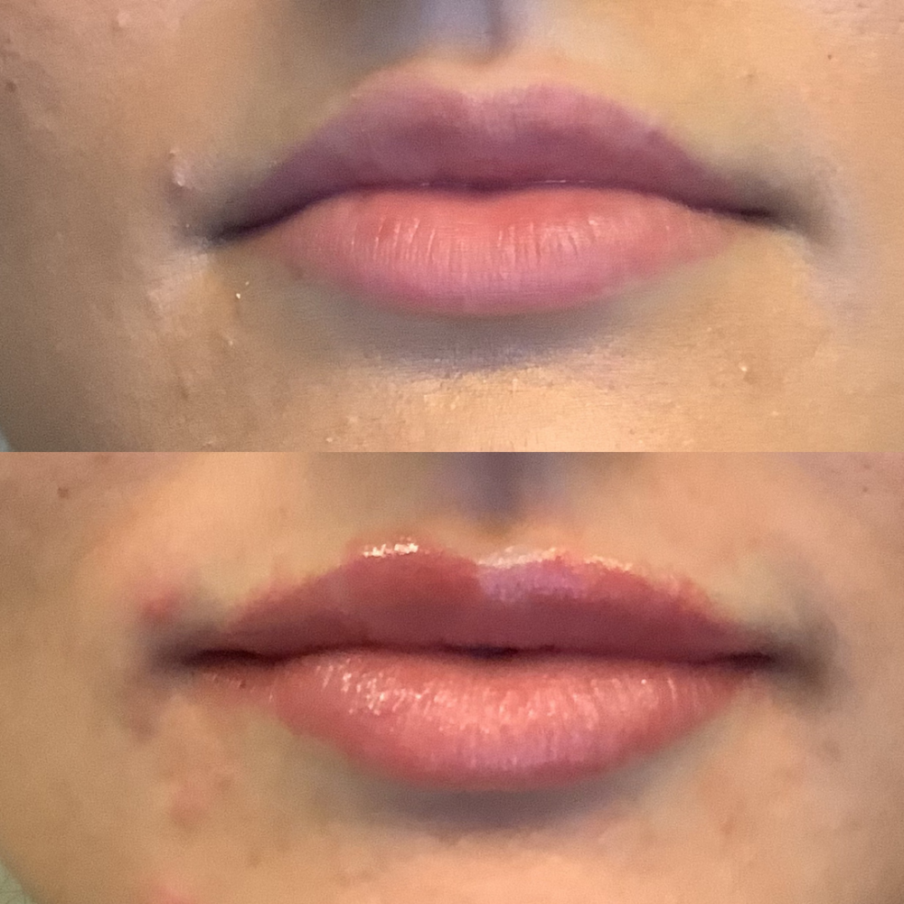 Lip Filler case #3344