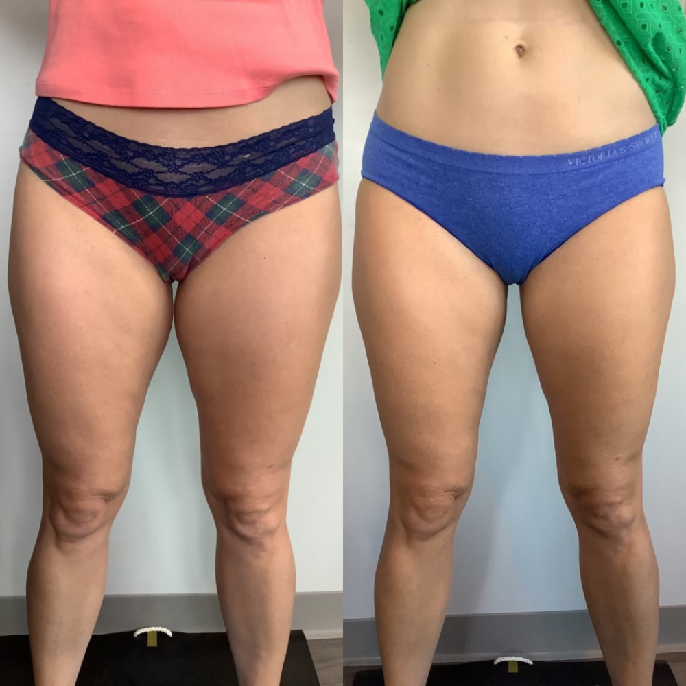 Coolsculpting case #3393