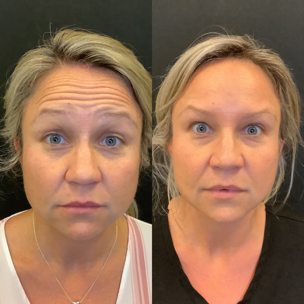 Neurotoxin (Botox) case #3244