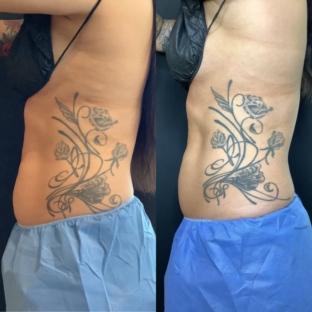 Coolsculpting case #3403