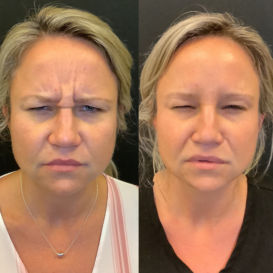 Neurotoxin (Botox) case #3437