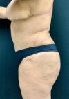 Tummy Tuck case #3099