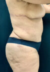 Tummy Tuck case #3099