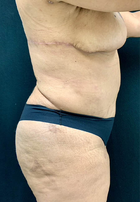 Tummy Tuck case #3099