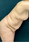 Tummy Tuck case #3099