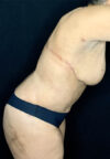 Tummy Tuck case #3099