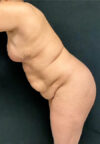 Tummy Tuck case #3099