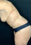 Tummy Tuck case #3099