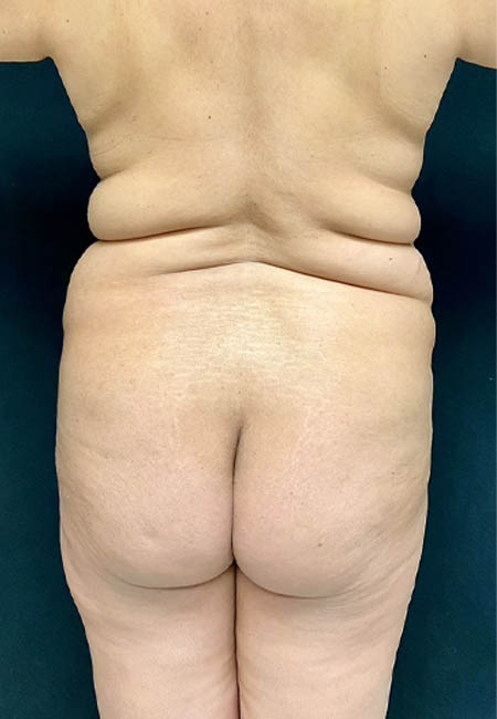 Tummy Tuck case #3099